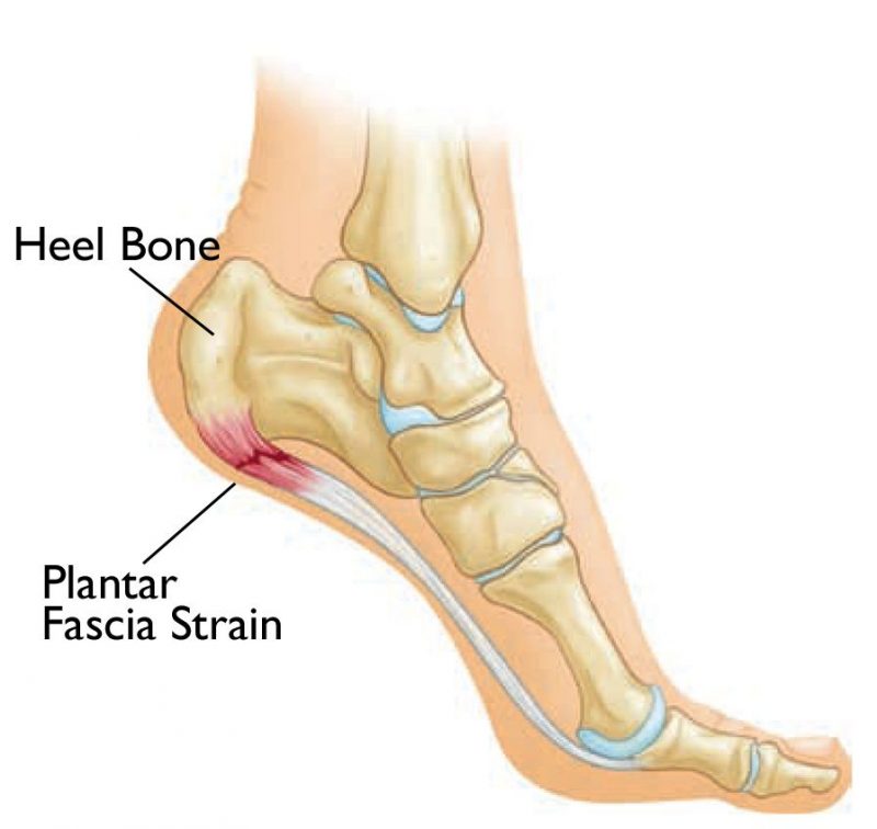 Plantar Fasciopathy Rivervale Physiotherapy